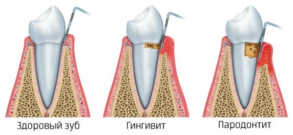 При данной патологии происходит постепенное разрушение связи корня зуба с челюстной костной тканью