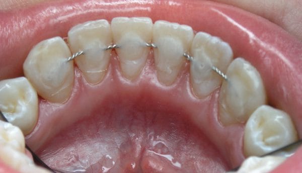 Армидная нить как бы связывает в единую конструкцию группу шатающихся зубов, исключает подвижность отдельных зубов