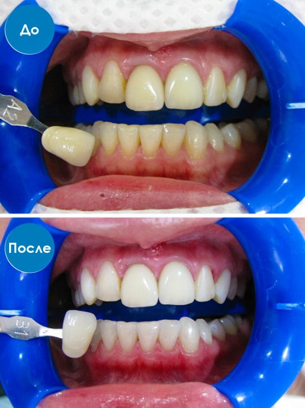 Отбеливание зубов системой ZOOM происходит путем взаимодействия безкислотного геля и специальной лампы
