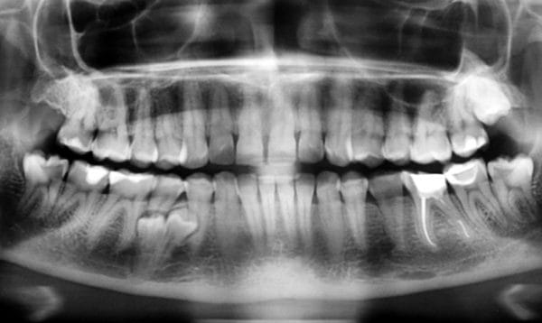 Рентгенографии позволяет получить сведения о зубах нижней и верхней челюсти, корневых каналах, состоянии тканей пародонта