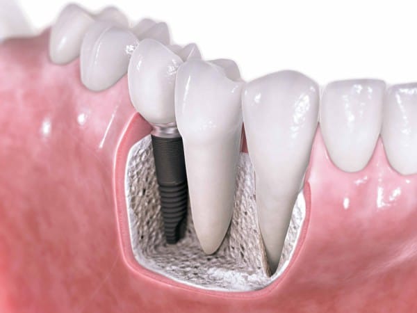 Имплантация зубов в нашем стоматологическом центре представляет собой эффективную и качественную процедуру