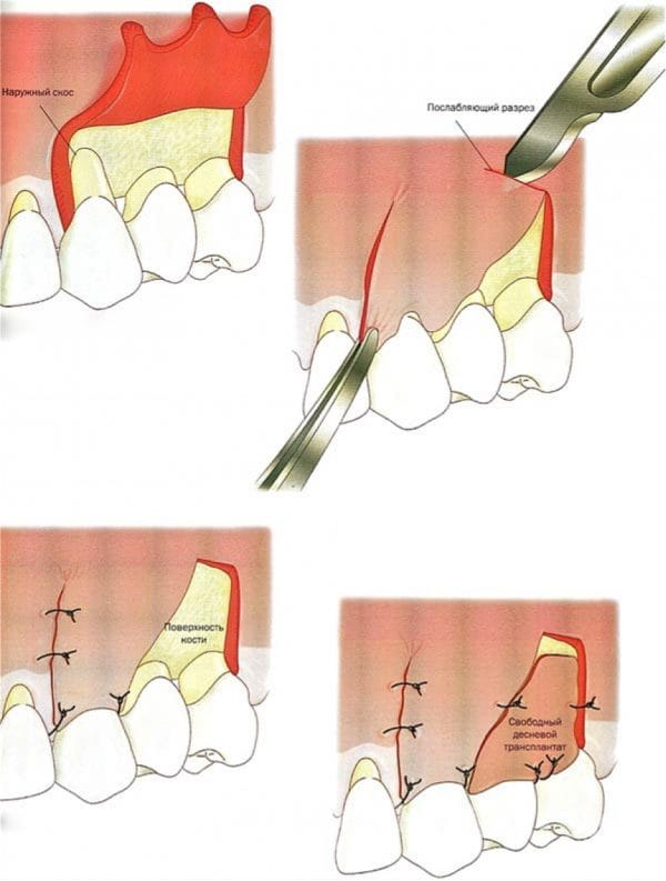 Лоскутная операция в стоматологии является одной из немногих методик, которая не только позволяет стабилизировать пародонтит