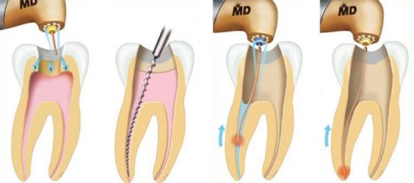 Лечение начинается с раскрытия кариозной полости, далее стоматологу необходимо убрать пораженный дентин и очистить канал от инфекции