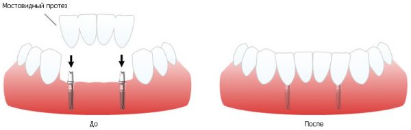 Мостовидный зубной протез