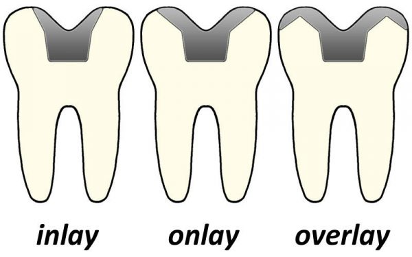 Типы зубных вкладок