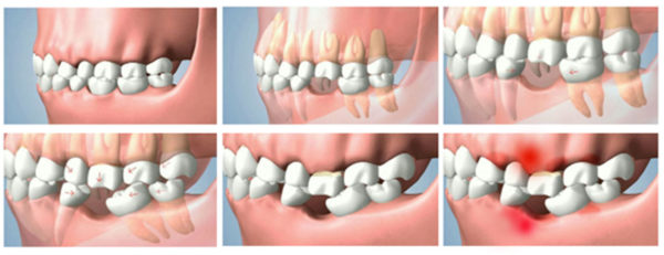Сложное протезирование при утрате зубов