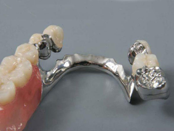 Сложное протезирование зубов - бюгельные протезы