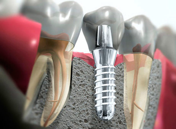 Замена зубных имплантов