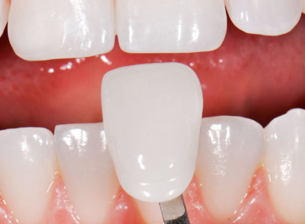 Зубное протезирование винирами
