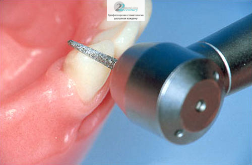 Обточка зубов под коронку после протезирования