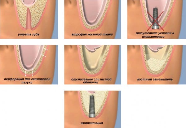 Суть операции заключается в наращивании массива костной ткани верхней челюсти при помощи определенных хирургических манипуляций и материалов