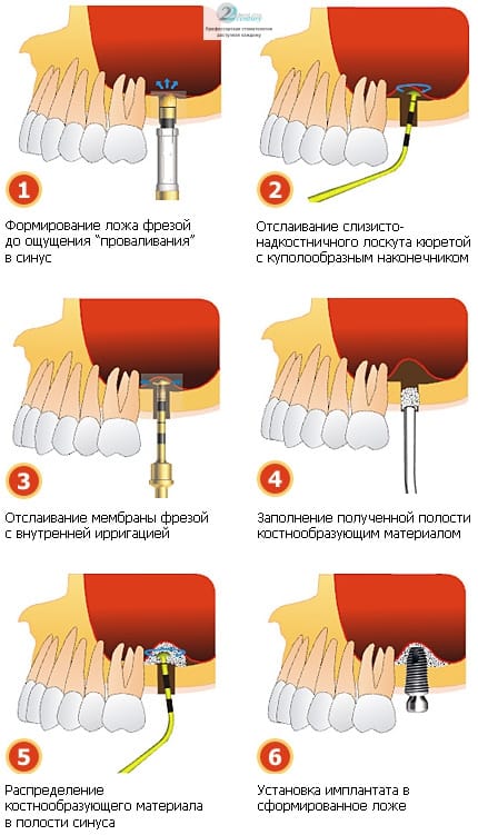 Операция закрытого синус-лифтинга – это малоинвазивная процедура, проводимая на верхней челюсти в месте установки имплантата