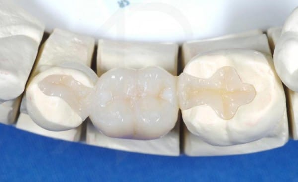 Вкладка в зуб под коронку может быть изготовлена на различной основе