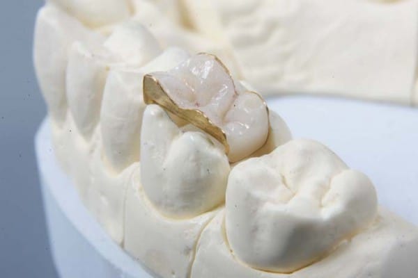Клиника “22 век” рекомендует зубные вкладки в качестве микропротезирования