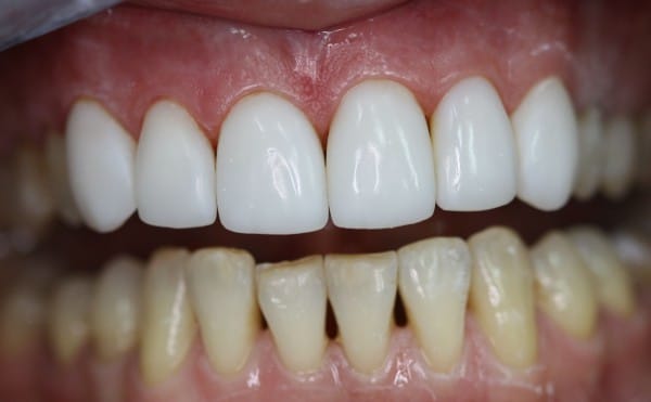 Виниры используются для реставрации зубов, позволяя нивелировать косметические дефекты передних зубов 