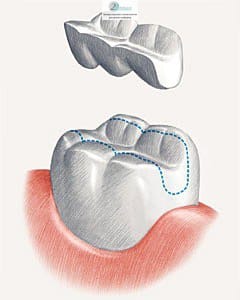 Протезирование зубов восстановительными вкладками