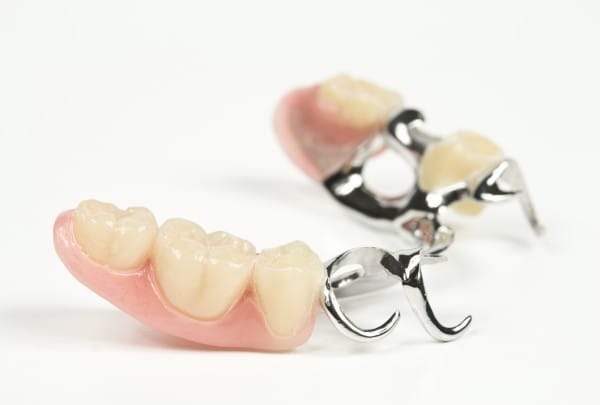 Данный вид протезирования особенно эффективен в случаях, так называемых концевых дефектов зубного ряда, когда утраченные зубы являются последними в ряду