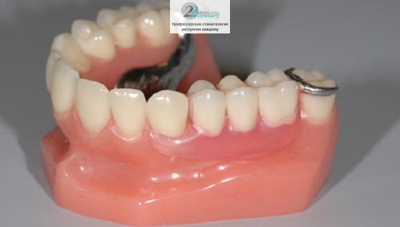 Кламмеры – это специальные крючки, которые обхватывают в основании здоровый зуб и отвечают за надежную фиксацию протеза