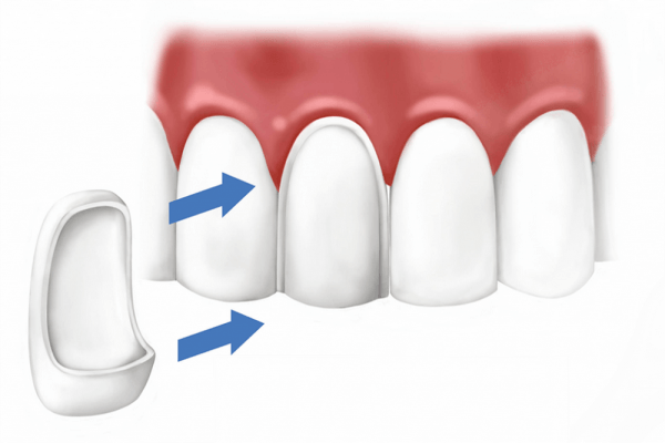 Виниры – это керамические или композитные накладки на зубы, которые помогут восстановить красивую форму и цвет зубов, защитить их от повреждений