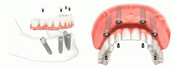 Имплантация зубов по технологии all-on-four (все на четыре) дает возможность восстановления зубного ряда при полном отсутствии зубов на верхней или нижней челюсти. При этом имплантат не ставится для каждого зуба