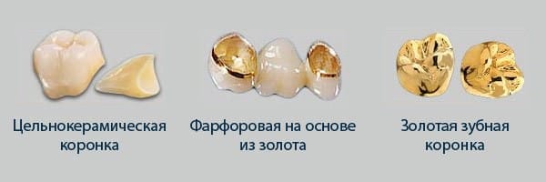 Виды зубных коронок