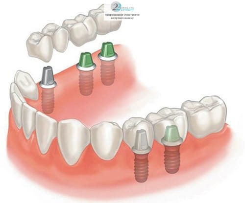 В большинстве случаев зубной мост является несъемным протезом
