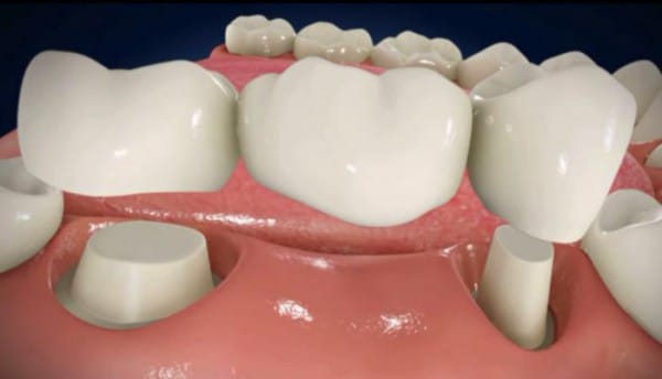 Зубные мосты – вид зубных протезов, при помощи которых восстанавливается целостность зубного ряда, в котором отсутствует один или несколько зубов