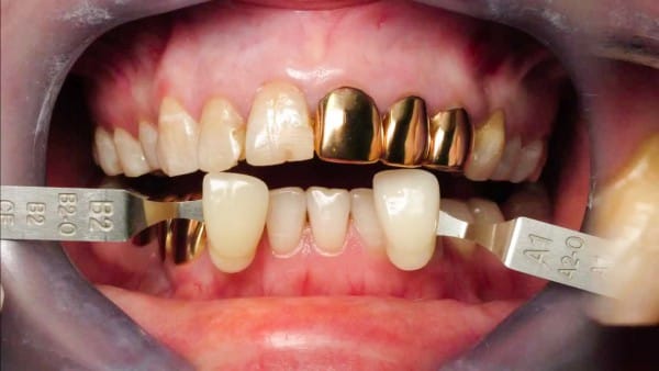 Один из классических способов протезирования в стоматологии – золотые коронки на зубе