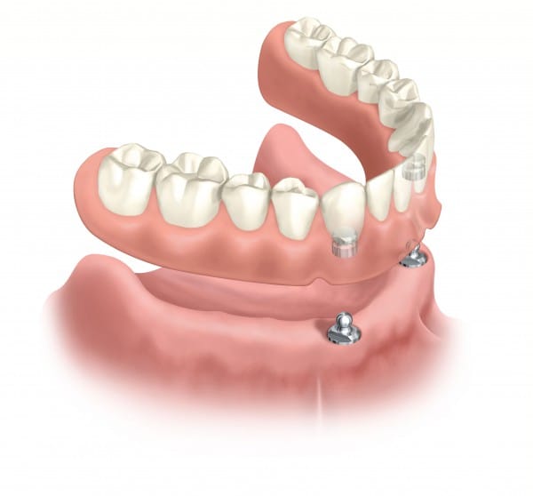 Часто пациенты выбирают именно этот вид восстановления зубов, устанавливая пластиночные протезы как съёмные или постоянные